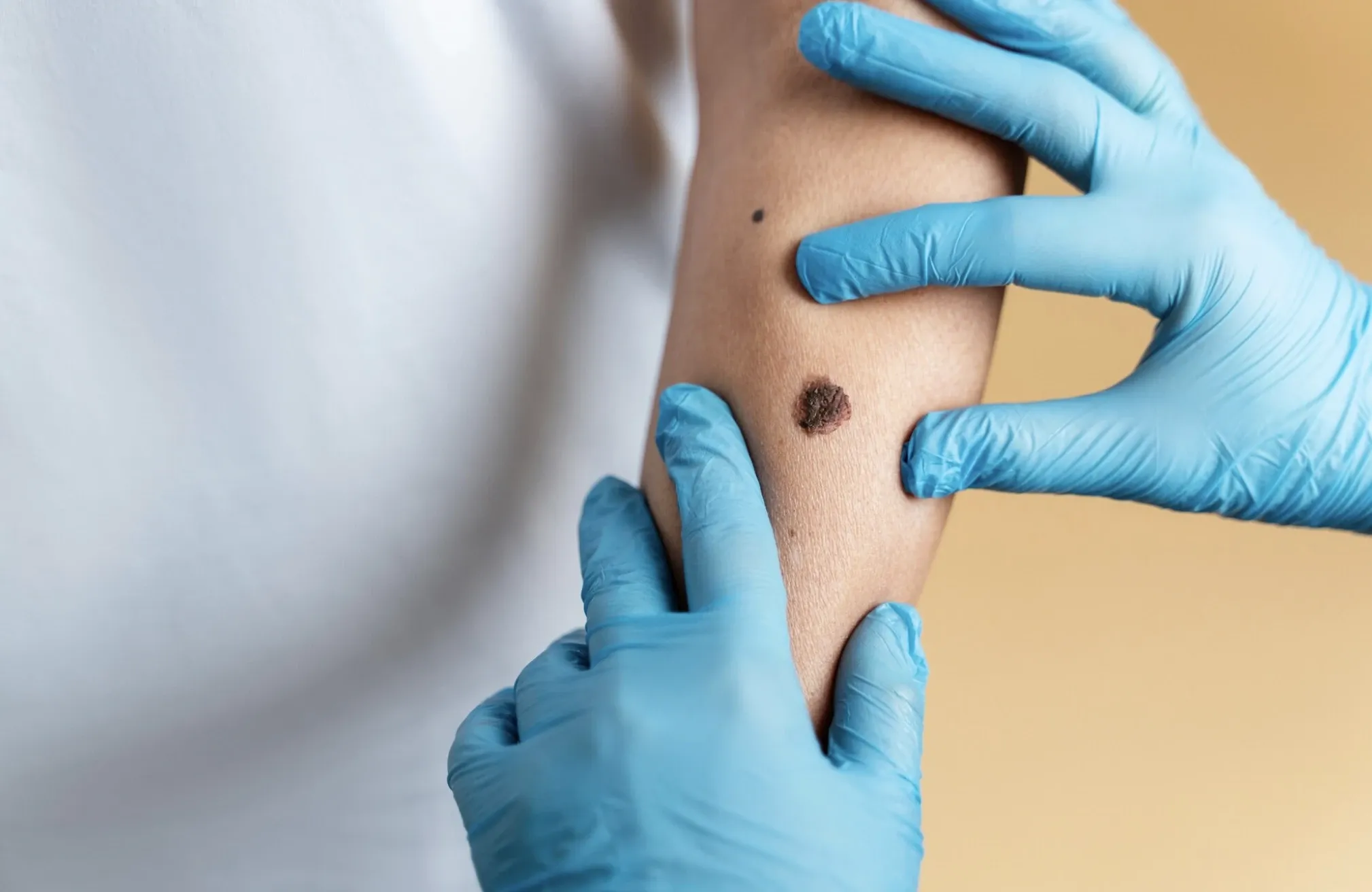 Родимки, папіломи, плями: які новоутворення на шкірі не можна ігнорувати